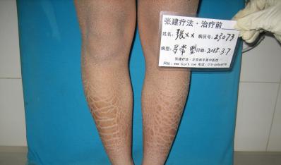 杭州男孩治好魚鱗考上大學(xué)自由綻放