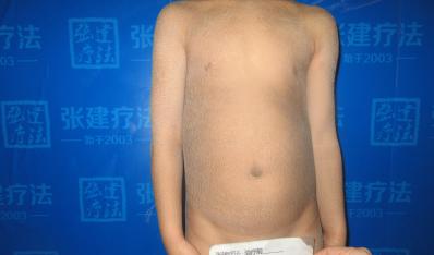 河北邢臺(tái)男孩克服層層困難重獲新生