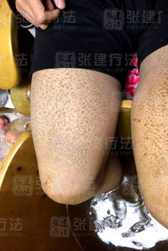 魚鱗皮膚病