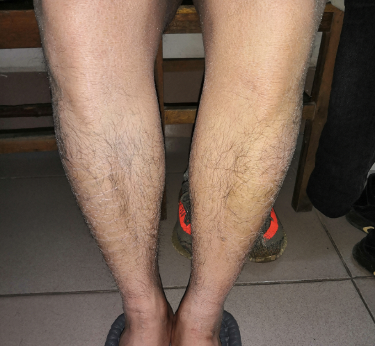 魚(yú)鱗皮膚病