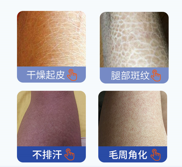 魚鱗皮膚治療